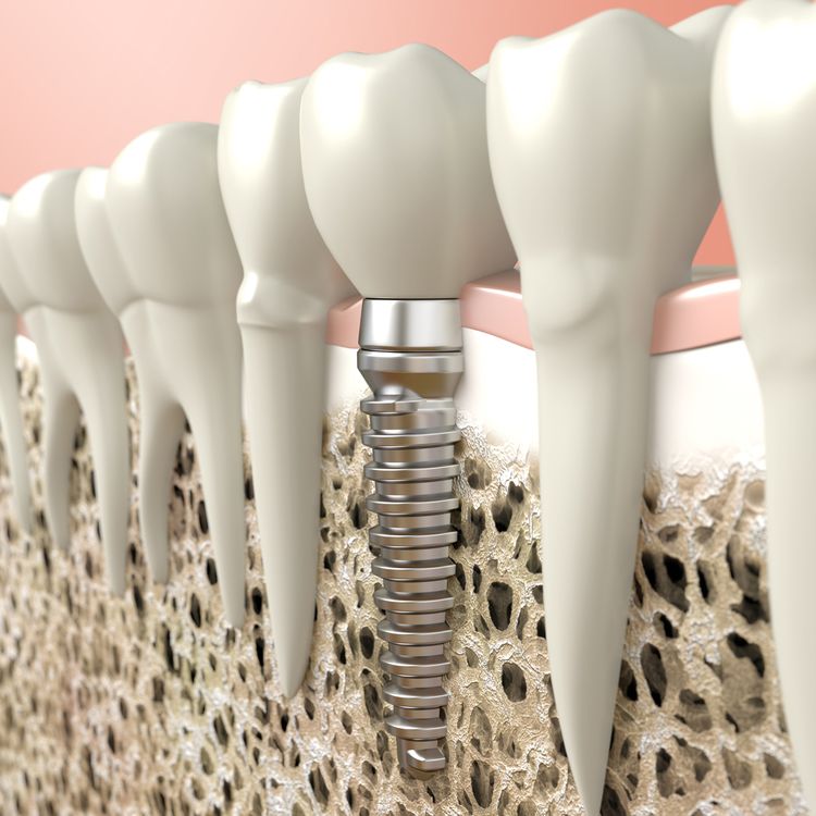 Illustration of dental implant