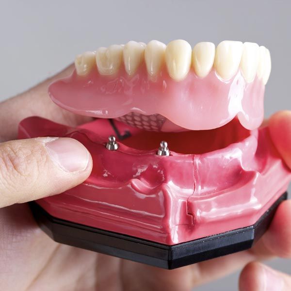 Model of jaw and implant denture