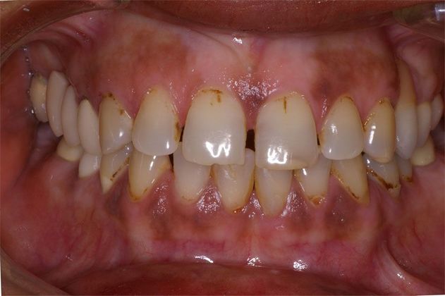 Smile Montreal Patient Before Porcelain Veneers procedure